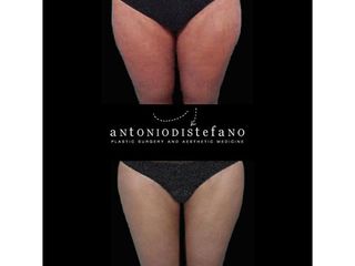 Liposuzione prima e dopo