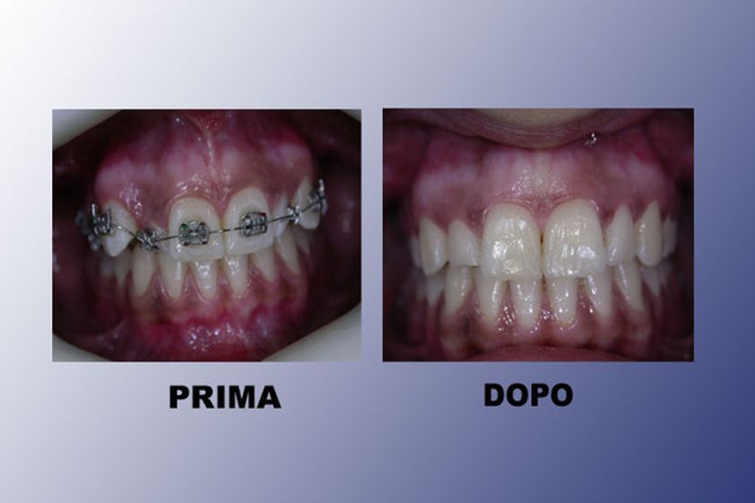 Ortodonzia prima e dopo - 752881