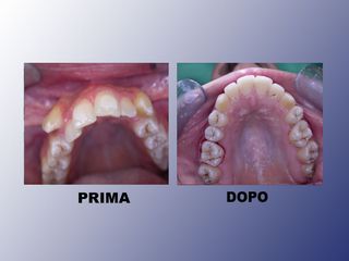 Ortodonzia prima e dopo