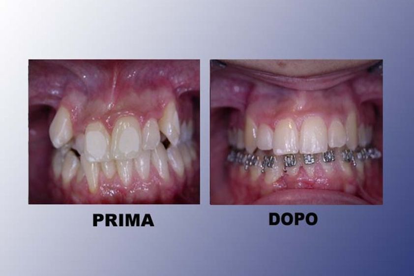 Ortodonzia prima e dopo - 752884