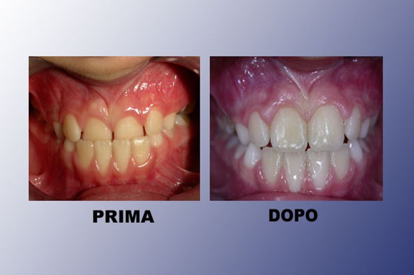 Ortodonzia prima e dopo - 752885