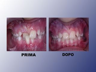 Ortodonzia prima e dopo