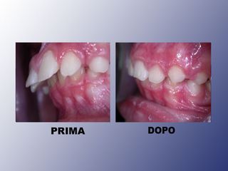 Ortodonzia prima e dopo