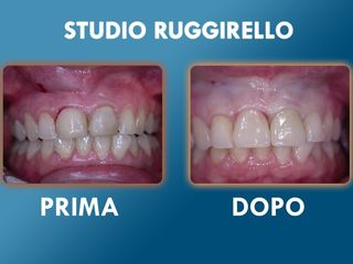 Estetica dentale prima e dopo