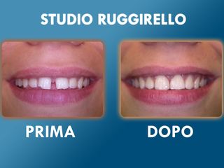 Estetica dentale prima e dopo