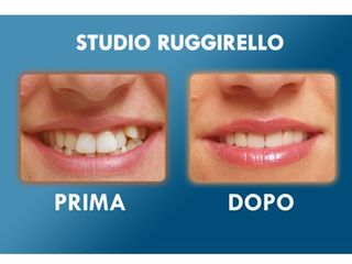 Estetica dentale prima e dopo