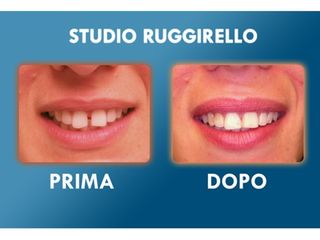 Estetica dentale prima e dopo