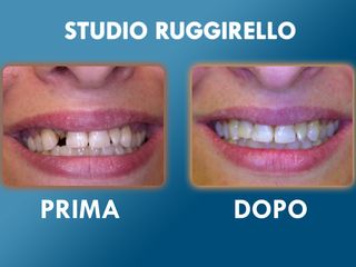 Estetica dentale prima e dopo