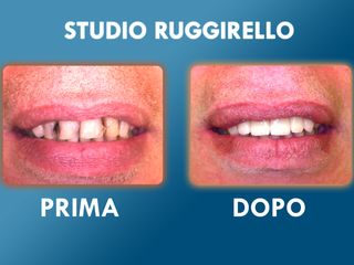 Estetica dentale prima e dopo