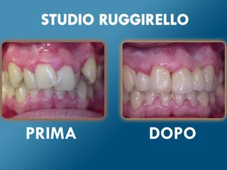 Estetica dentale prima e dopo