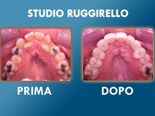 Estetica dentale prima e dopo