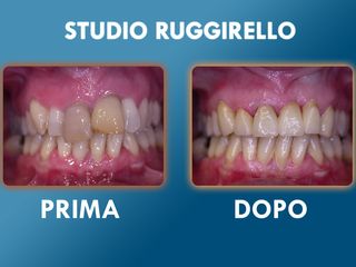 Estetica dentale prima e dopo