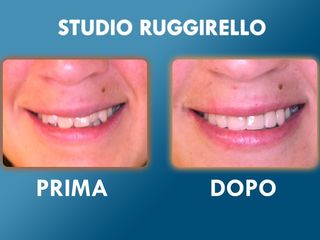 Estetica dentale prima e dopo