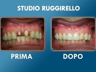 Estetica dentale prima e dopo