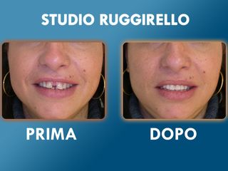 Estetica dentale prima e dopo