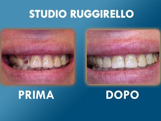 Estetica dentale prima e dopo