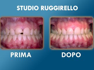 Estetica dentale prima e dopo