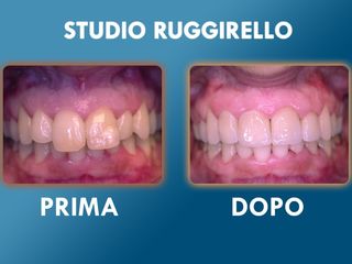 Estetica dentale prima e dopo