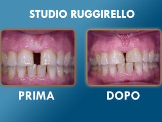 Estetica dentale prima e dopo