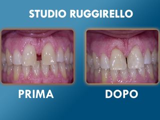 Estetica dentale prima e dopo