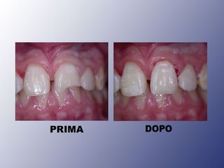 Estetica dentale prima e dopo