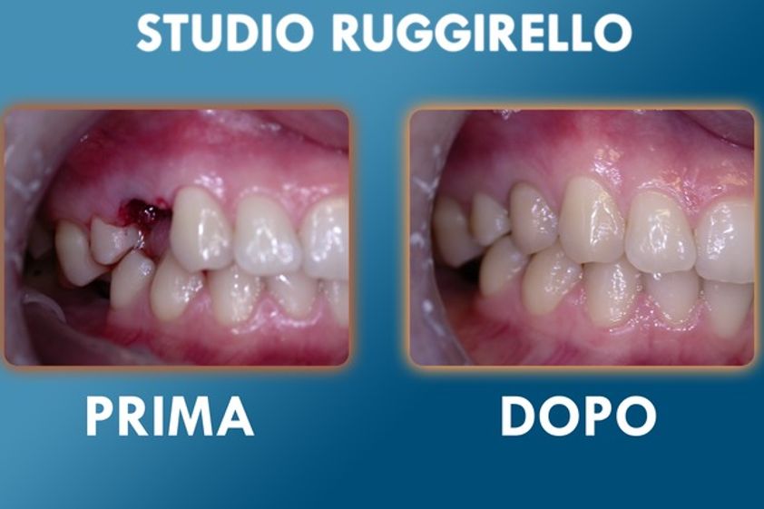 Implantologia prima e dopo - 752913