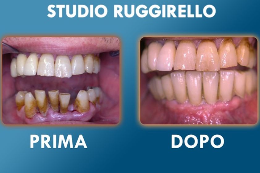 Implantologia prima e dopo - 752915