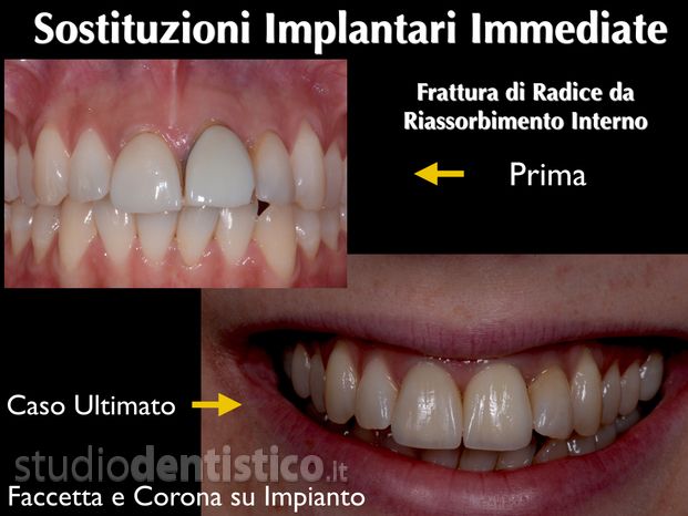 Dental veneers - Studio Benzi - Dental Clinic Vigevano