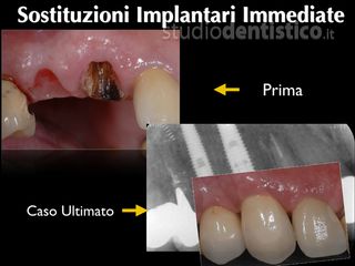 sostituzione implantare prima dopo