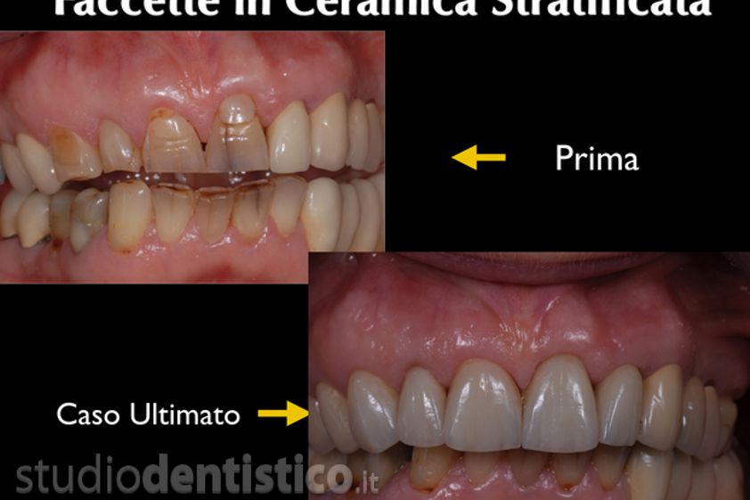 Faccette dentali prima e dopo - 759486