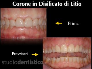 corone prima dopo