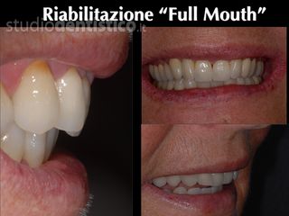 riabilitazione denti prima dopo