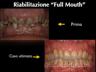 riabilitazione denti prima dopo