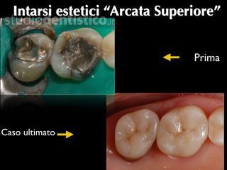 intarsi denti prima dopo