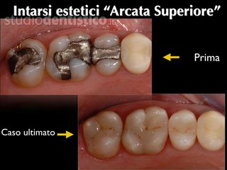 intarsi denti prima dopo