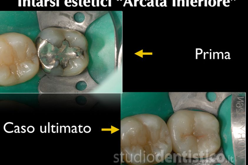Implantologia prima e dopo - 759492