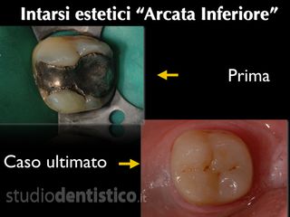 intarsi denti prima dopo