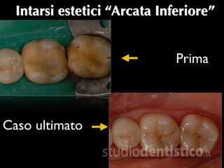 intarsi denti prima dopo