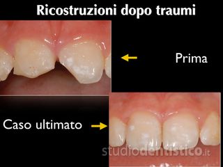 ricostruzione denti prima dopo