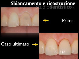 Sbiancamento dentale prima dopo