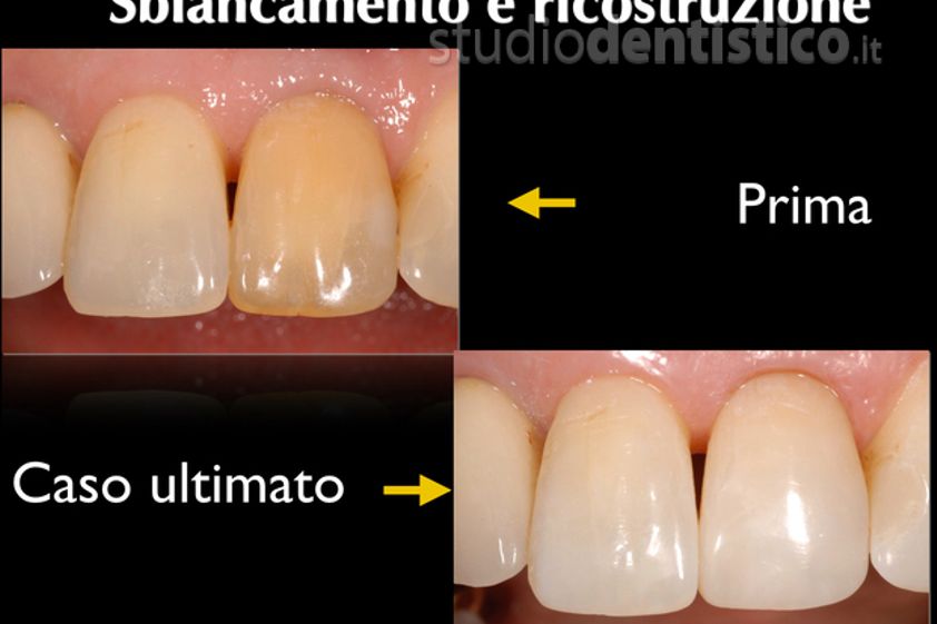 Sbiancamento denti prima e dopo - 759497