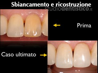 Sbiancamento dentale prima dopo