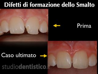 ricostruzione denti prima dopo