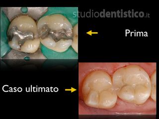 Otturazioni Estetiche Posteriori prima dopo