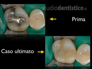 Otturazioni Estetiche Posteriori prima dopo