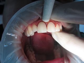 Esito intervento d'estetica dentale