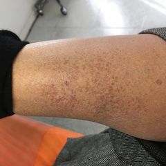 Riduzione capillari con laser prima seduta