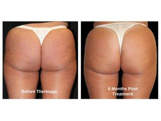Glutei prima e dopo