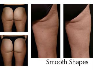smooth shapes laser prima e dopo