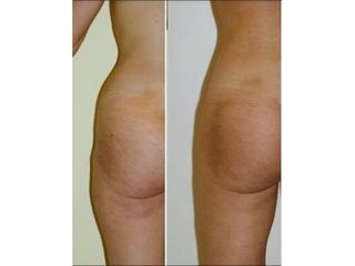 Liposuzione - Dottor Gianluca Campiglio